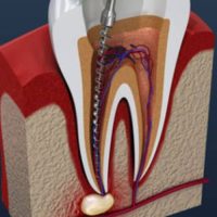 15 Root Canals in Northside Richmond VA, Root Canals in Northside Richmond, Root Canals in Northside VA, Root Canals in Richmond VA, Dentist VA xr:d:DAFsRcKusVw:2,j:5584864057788224749,t:23082213